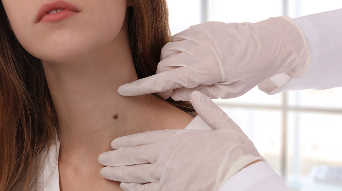 Moles/Tags Removal Treatment In Mumbai at Mumbai Cosmetic Centre