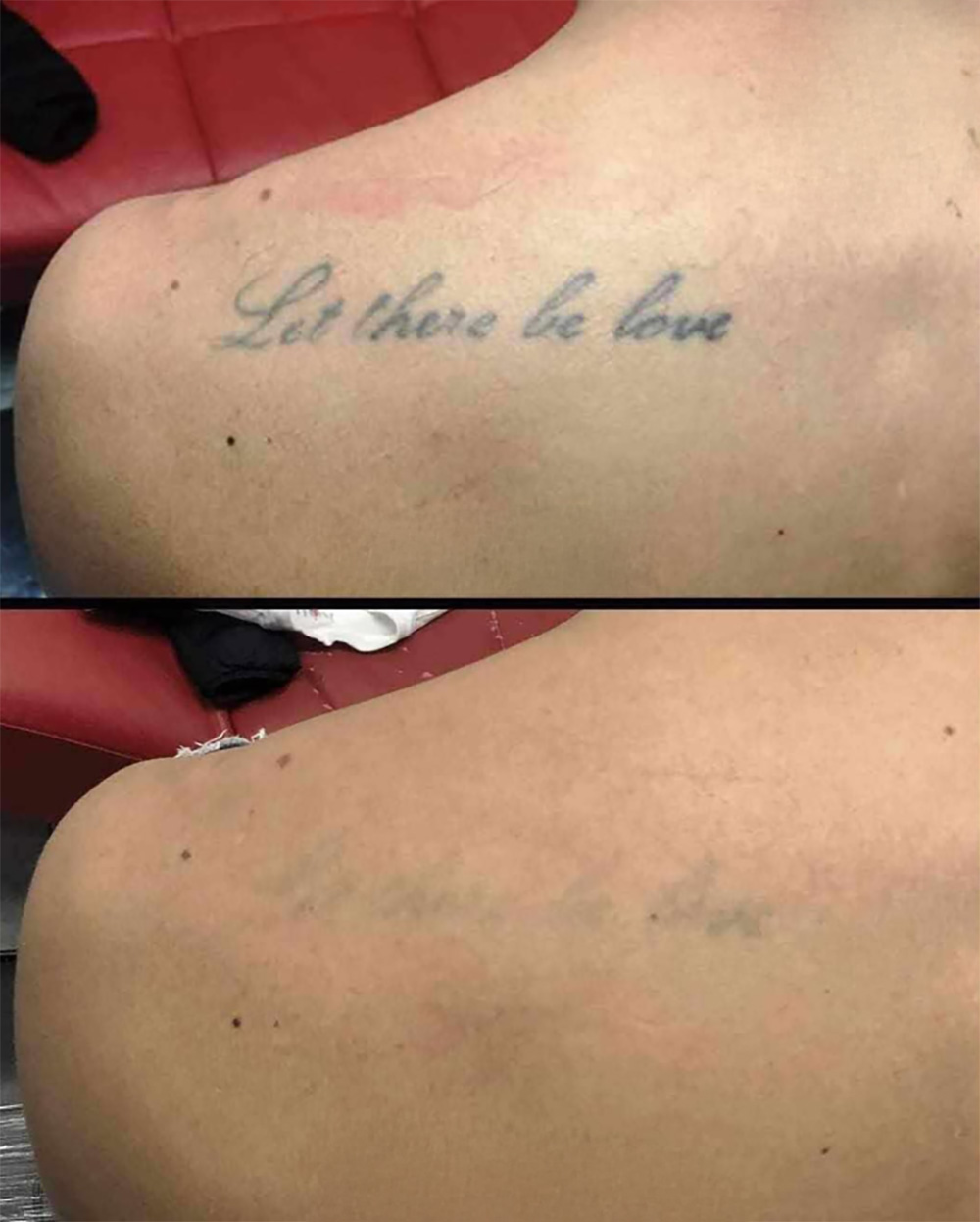 Laser Tattoo Removal in mumbai at mumbai cosmetic centre, Before After Result 1
