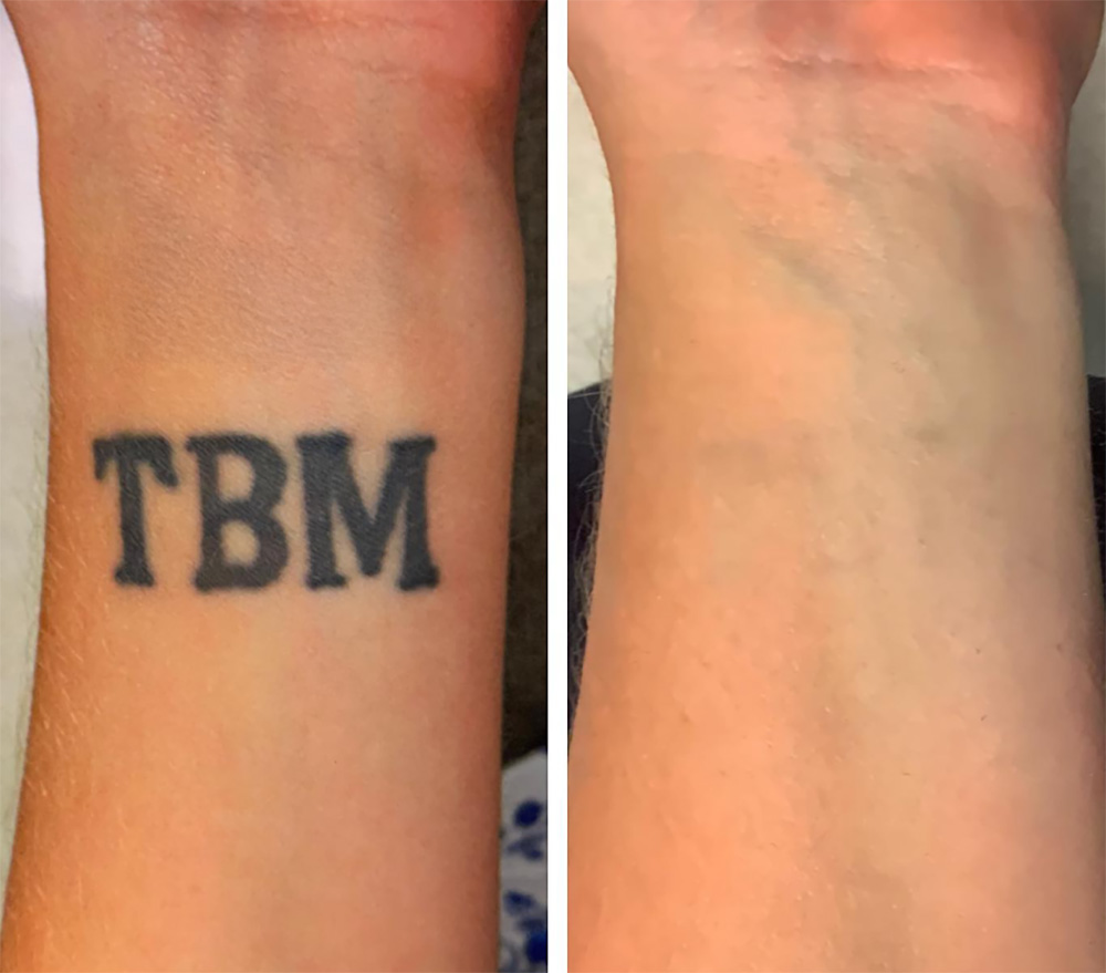 Laser Tattoo Removal in mumbai at mumbai cosmetic centre, Before After Result 2