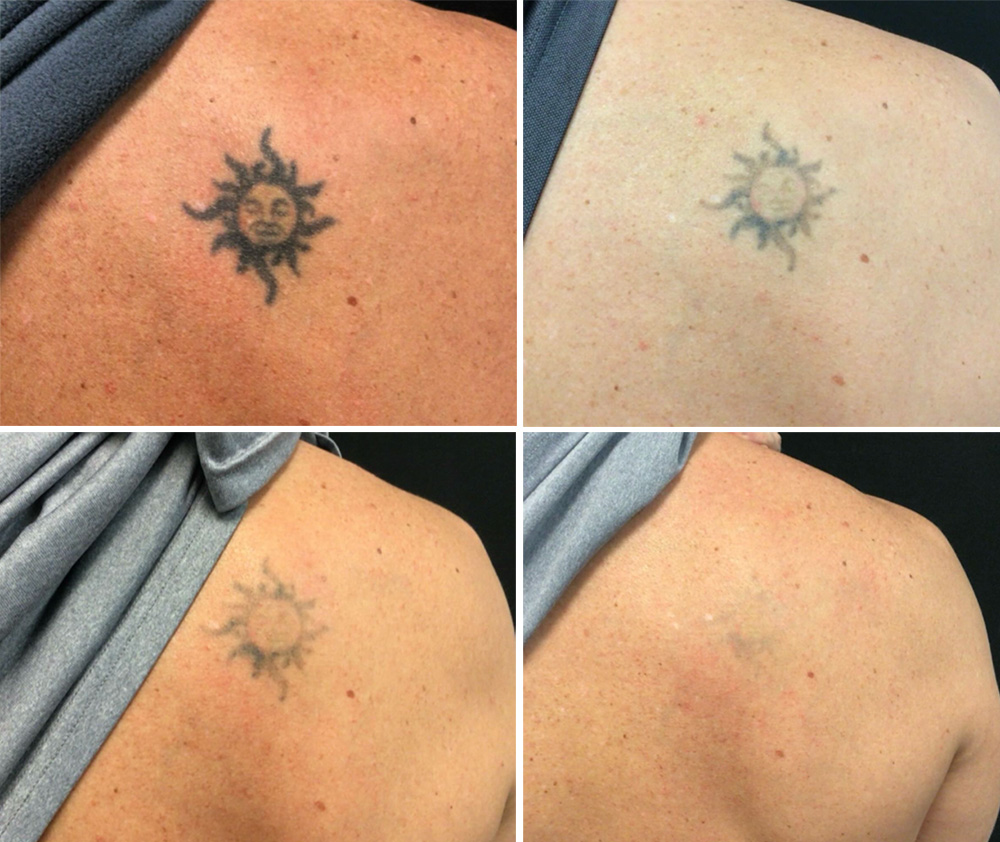Laser Tattoo Removal in mumbai at mumbai cosmetic centre, Before After Result 3