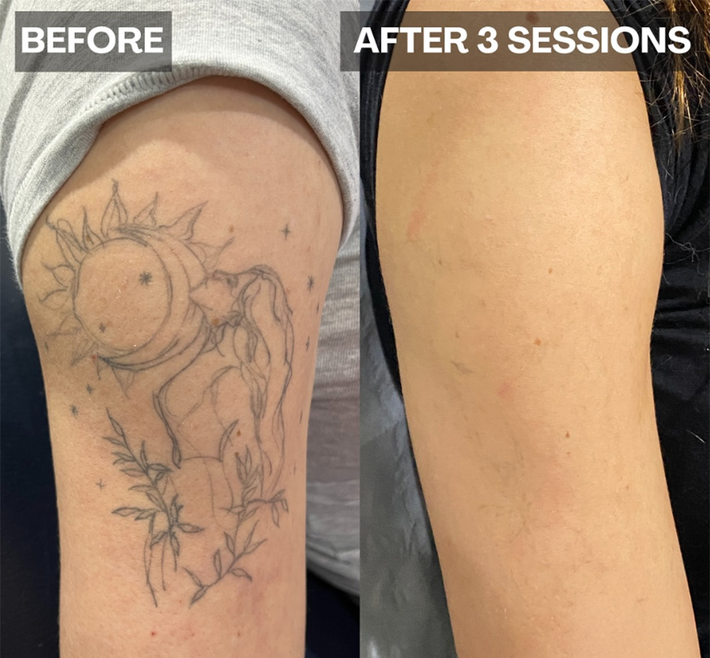 Laser Tattoo Removal in mumbai at mumbai cosmetic centre, Before After Result 4